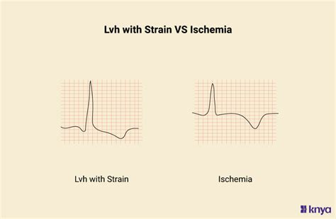 lv strain french|lvh strain pattern vs ischemia.